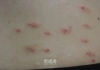 一觉醒来，身上密密麻麻！近期高发， 很多人中招！